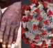 Experts Urge WHO And Governments To Take Stronger Action Against Monkeypox